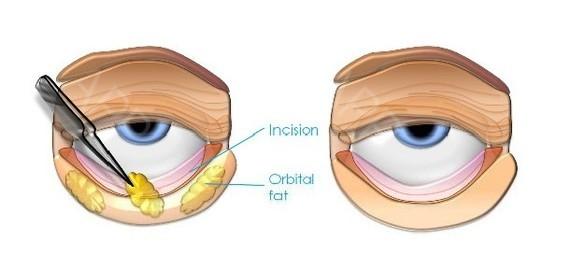 眼袋下面的纹是什么纹，为什么眼睛下面有眼袋纹（你又知道这黑三角是哪吗）