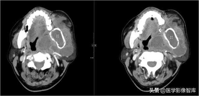 颞间隙感染，颞间隙感染切开部位（颌面部间隙感染影像诊断及各间隙解剖介绍）