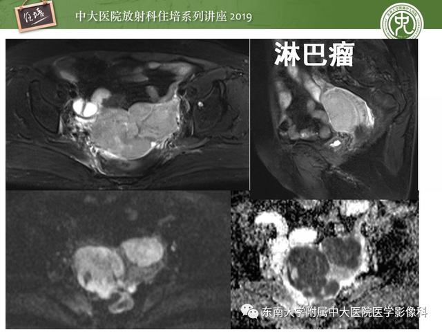 子宫颈影像解剖，子宫详细解剖及磁共振信号分析