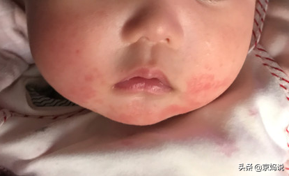 宝宝湿疹怎么办，一个月宝宝湿疹怎么办（5点护理+合理用药）