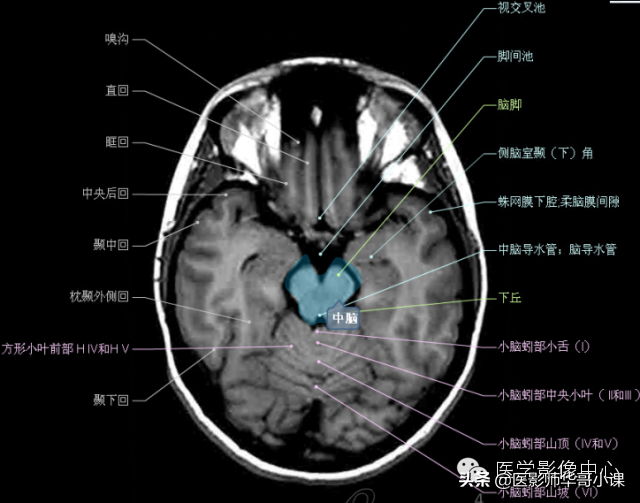 颅脑mri(头部MRI)插图(34)