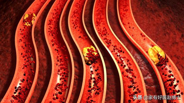 脉搏波传导速度，什么叫做脉搏波速度PWV（“血管老化”的五大常见征象）