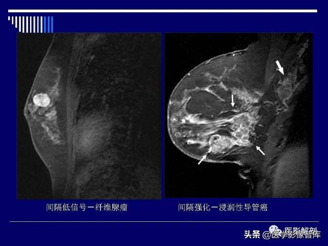 乳房解剖学基础知识，乳腺解剖及乳腺各病变影像诊断与鉴别