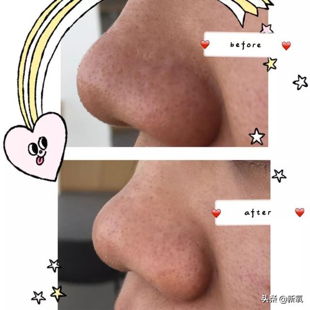 怎么去黑头小窍门，五个去黑头方法（我把火爆全网的去黑头方法试了一遍）