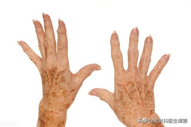 老年疣的去除方法，老年疣的去除方法 药（老年斑/脂溢性角化可以如何治疗）