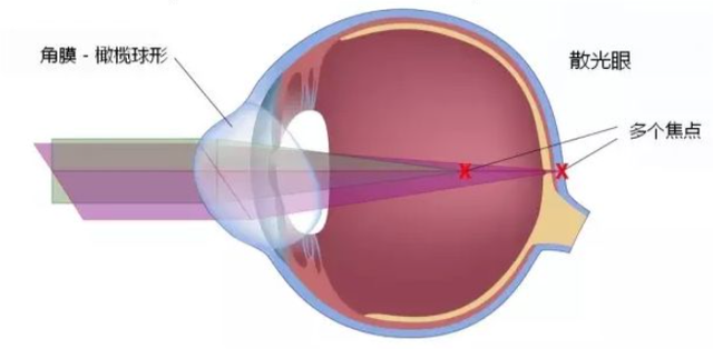 眼科cyl多少是正常，眼科cyl-1.25（镜片镜架选择总攻略）
