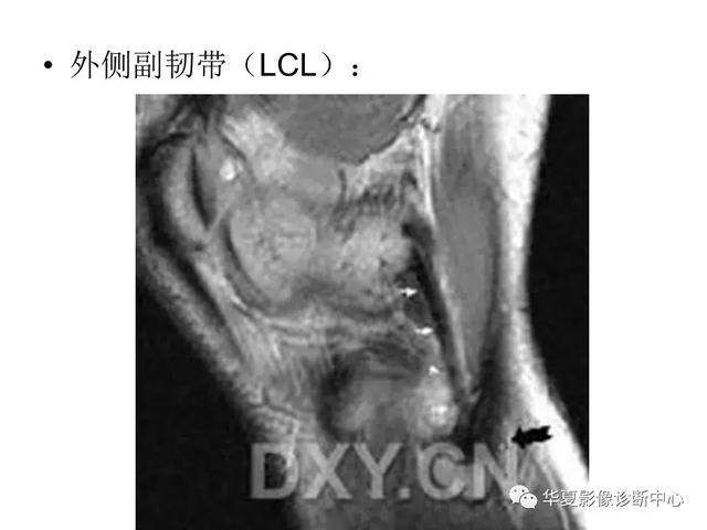 膝关节解剖结构图，膝盖解剖图示意图（膝关节MRI之正常解剖综述）