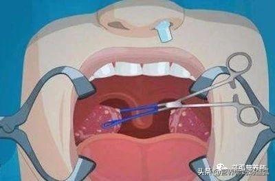 扁桃体发炎十大禁忌，扁桃体炎需三分治七分养