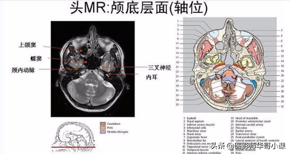 颅脑mri(头部MRI)插图(80)