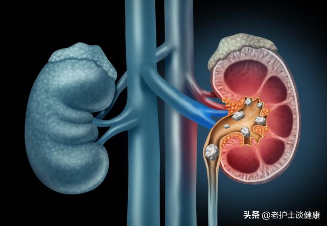 肾结石疼痛怎么办，产妇肾结石疼痛怎么办（肾结石剧痛难忍）