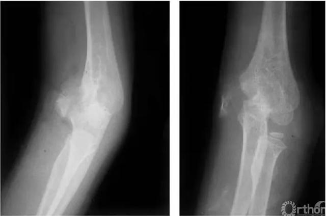 肱骨长是什么意思，骨科常见疾病X线解析之肱骨内髁骨折
