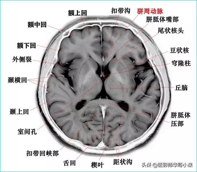 頭顱ct解剖圖,頭部骨骼結構圖(顱腦磁共振mri解剖結構以及高清圖譜)