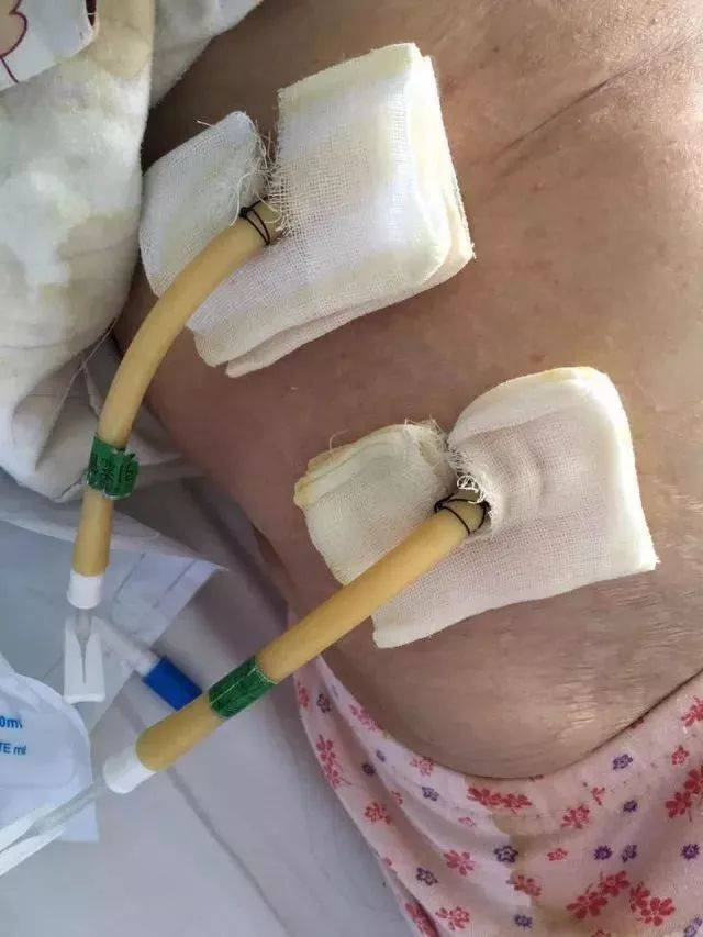 胆囊切除后引流管作用(三分治疗) - 行就行