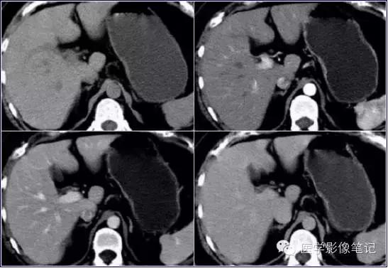 吃赖尿虾的好处，孕妇可以吃濑尿虾吗中期（这8种肝脏变异）