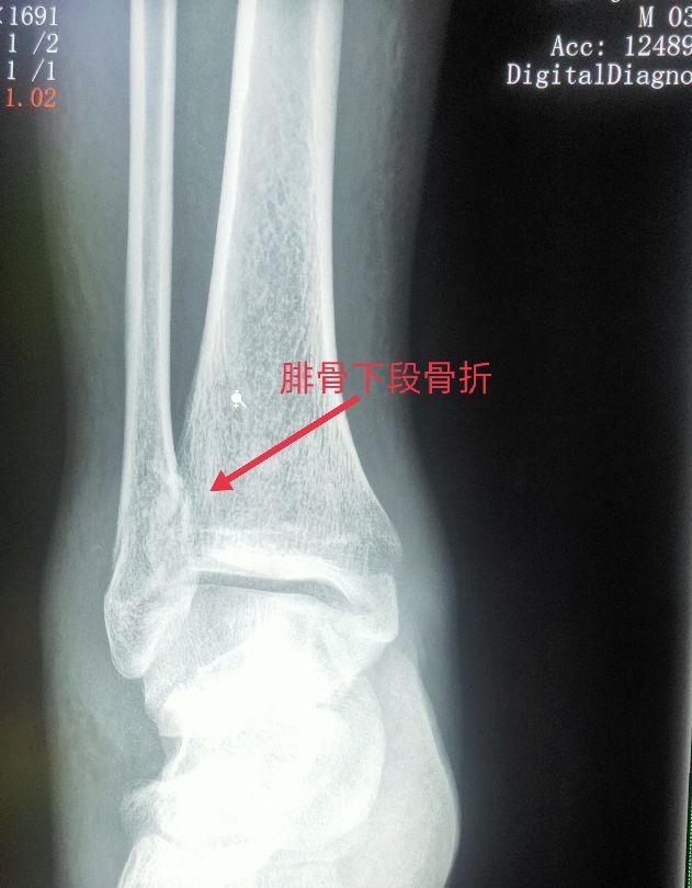 脚踝是哪个部位图解，脚踝是哪个部位图解视频（学习《X线读片指南》骨、关节系统——踝关节）