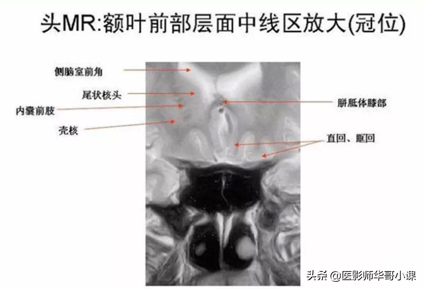 颅脑mri(头部MRI)插图(63)