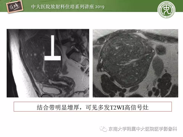 子宫颈影像解剖，子宫详细解剖及磁共振信号分析