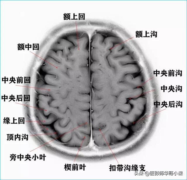 头颅ct解剖图，头部骨骼结构图（颅脑磁共振MRI解剖结构以及高清图谱）