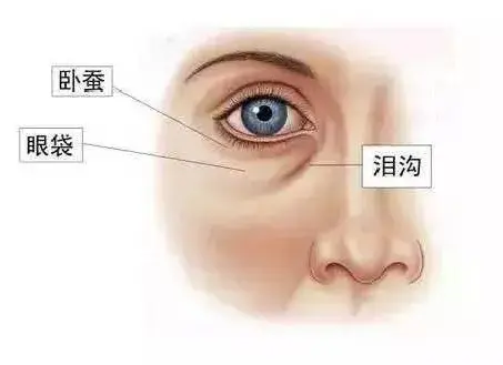上海九院眼袋失败案例（是显老还是甜美）