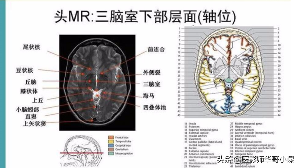 颅脑mri(头部MRI)插图(73)