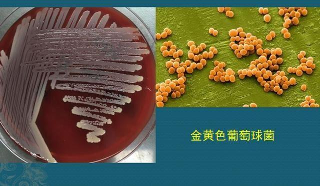 碘酒过期了还能用吗，过期了的碘酒还能不能用（硬扛3天不吃抗生素必后悔）