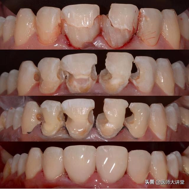 全口义齿制作，全口义齿图片（《假牙制作新方法》数字化创新镶牙代替传统镶牙时代来临了）