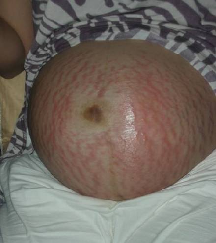 妊娠纹初期症状图片图片
