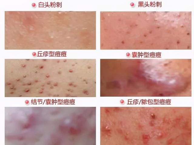 为什么越擦阿达帕林痘痘越多，脸上痘痘一直反反复复长个不停（痘痘痤疮治疗绕不过的“神器”阿达帕林）