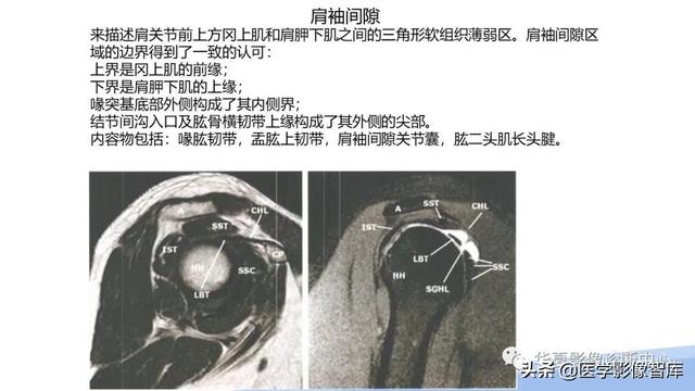 肩关节骨标志解剖图，全面掌握肩关节解剖
