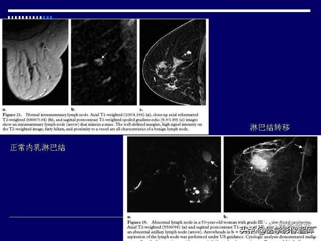 乳房解剖学基础知识，乳腺解剖及乳腺各病变影像诊断与鉴别