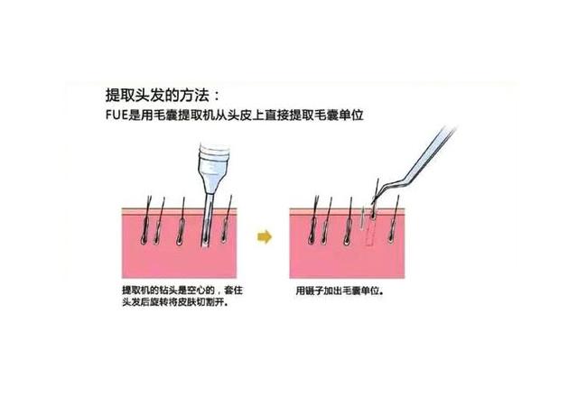 头发种植有三种技术，影响植发效果的重要原因之一