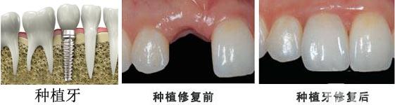 种牙好还是镶牙好，种牙与镶牙有什么区别哪个好一些（掉牙后，建议种牙还是装假牙）