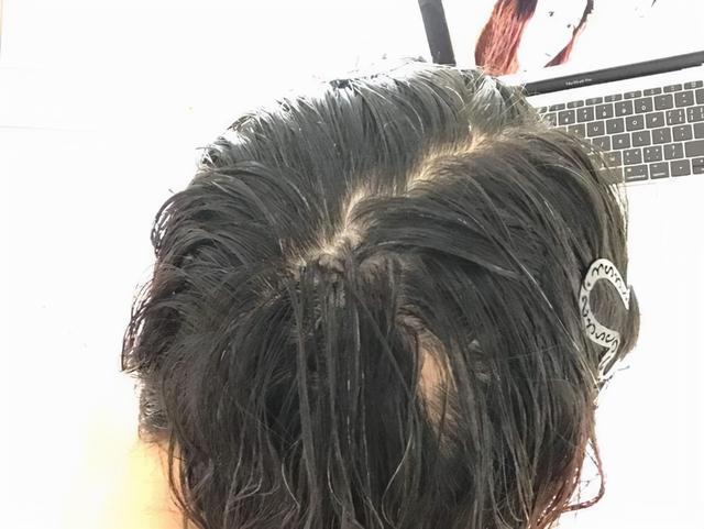 长时间用硫磺皂洗头有啥危害，广州一女子坚持用“硫磺皂水”洗头