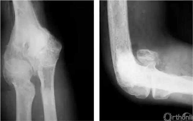 肱骨长是什么意思，骨科常见疾病X线解析之肱骨内髁骨折