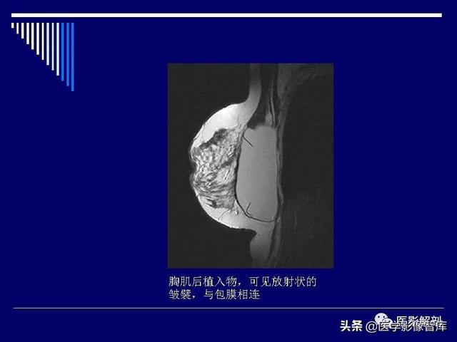 乳房解剖学基础知识，乳腺解剖及乳腺各病变影像诊断与鉴别