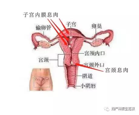 子宫息肉是不是一定要割掉，子宫息肉一定要切除吗（“子宫长息肉”了怎么破）