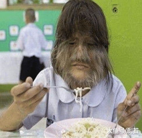 脸上长毛怎么办，用了烟酰胺脸上长毛怎么办（女孩身患“怪病”脸上长毛）