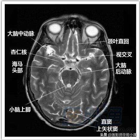 颅脑mri(头部MRI)插图(5)