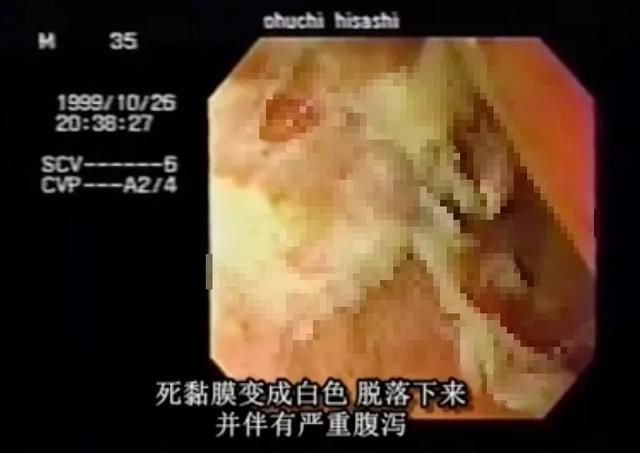 日本东海村核临界事故，日本东海村核临界事故百科（核辐射惨烈堪比十八层地狱）