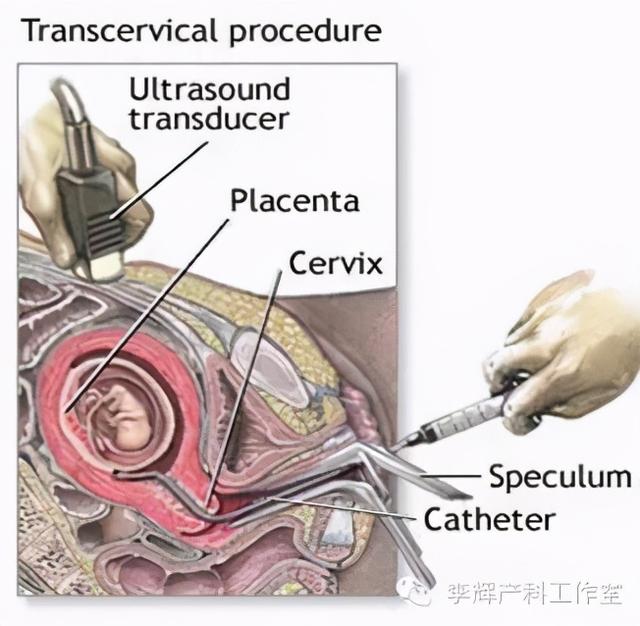 绒毛穿刺是什么，绒毛穿刺是什么会不会对胎儿造成影响（侵入性产前诊断技术有哪些）