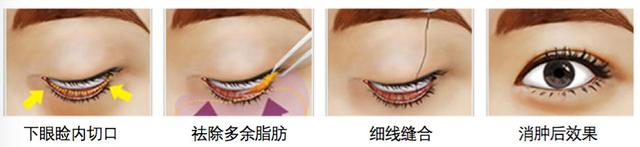 大眼袋怎么消除，大眼袋怎么消除（整形医生教您如何去除“大眼袋”）