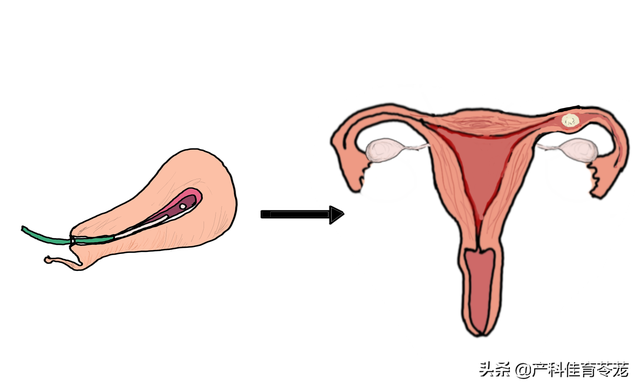 宫外孕必须手术吗，宫外孕一定要手术吗（宫外孕之你问我答）