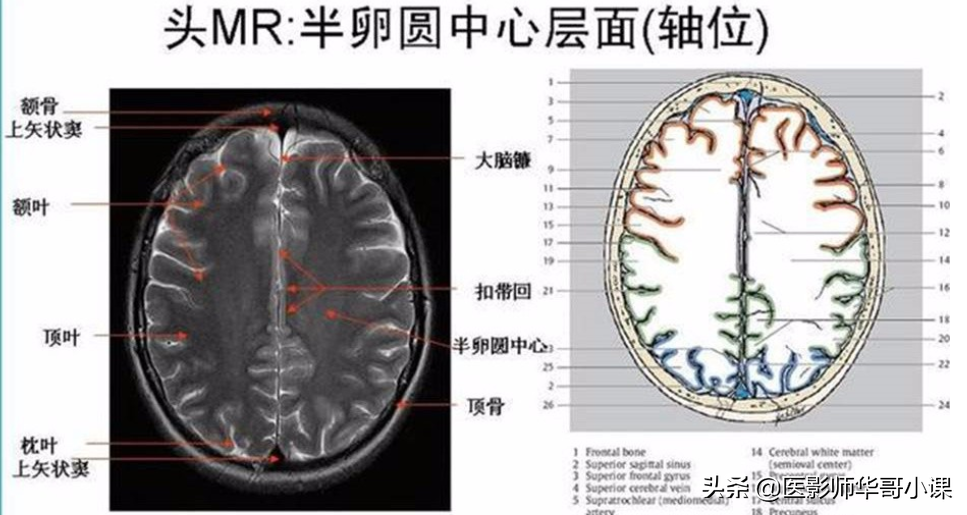 颅脑mri(头部MRI)插图(67)