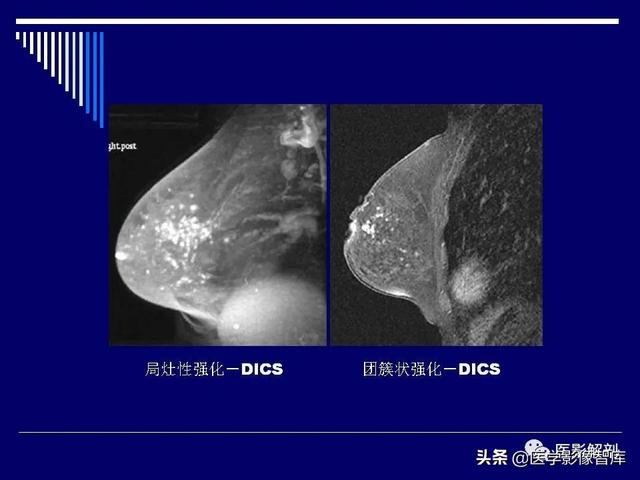 乳房解剖学基础知识，乳腺解剖及乳腺各病变影像诊断与鉴别