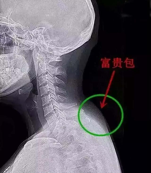 富贵包切除手术恢复需要多久 得了富贵包有必要去医院做手术吗，富贵包切除手术恢复需要多久（富贵包并不是富贵病）