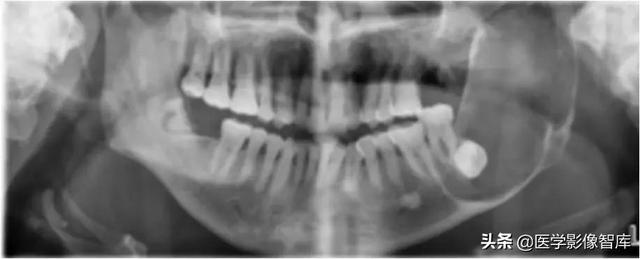 颞间隙感染，颞间隙感染切开部位（颌面部间隙感染影像诊断及各间隙解剖介绍）