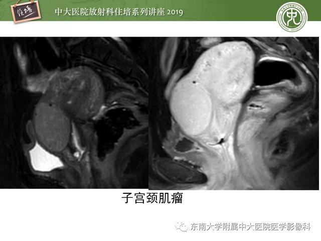 子宫颈影像解剖，子宫详细解剖及磁共振信号分析