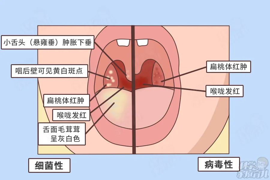 这个"嗓子病"很像感冒,宝宝不咳嗽比咳嗽更严重-大恒文化