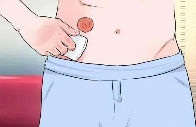 什么情况下要人造肛门，我国“造口人”超百万