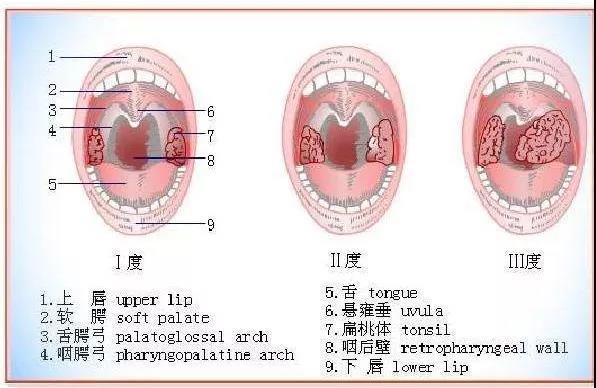 扁桃体肿大怎么办，成人扁桃体肿大怎么办（，“发热”——带你认识扁桃体的三度肿大）